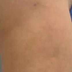 Cellulaze Before & After Patient #395