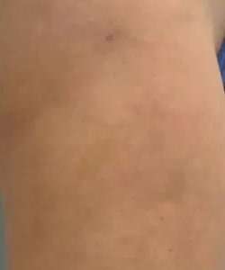 Cellulaze Before & After Patient #395