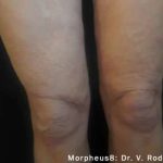 Morpheus8 Before & After Patient #398