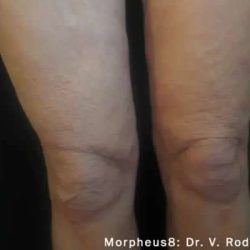 Morpheus8 Before & After Patient #398