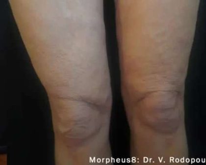 Morpheus8 Before & After Patient #398