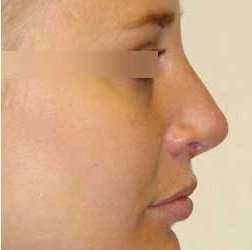 Rhinoplasty Before & After Patient #69