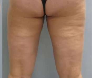 Smartlipo Vaser Lipo Before & After Patient #499