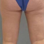Smartlipo Vaser Lipo Before & After Patient #516
