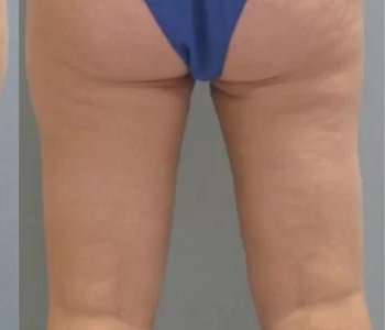 Smartlipo Vaser Lipo Before & After Patient #516