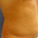 Smartlipo Vaser Lipo Before & After Patient #536