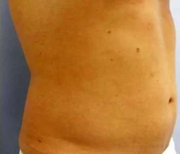 Smartlipo Vaser Lipo Before & After Patient #536