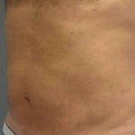 Smartlipo Vaser Lipo Before & After Patient #544