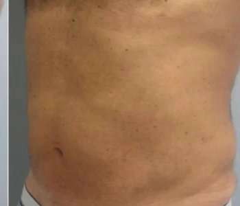 Smartlipo Vaser Lipo Before & After Patient #544