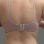 Smartlipo Vaser Lipo Before & After Patient #561