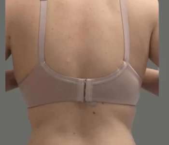 Smartlipo Vaser Lipo Before & After Patient #561