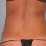 Smartlipo Vaser Lipo Before & After Patient #587