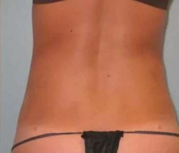 Smartlipo Vaser Lipo Before & After Patient #587