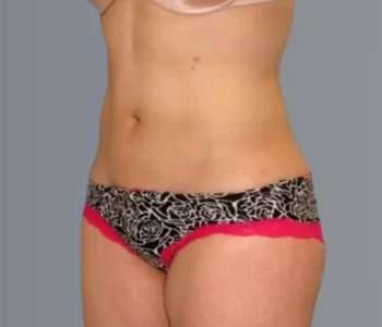 Smartlipo Vaser Lipo Before & After Patient #624