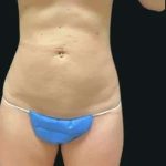 Smartlipo Vaser Lipo Before & After Patient #680