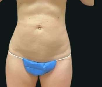 Smartlipo Vaser Lipo Before & After Patient #680
