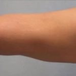 Smartlipo Vaser Lipo Before & After Patient #483