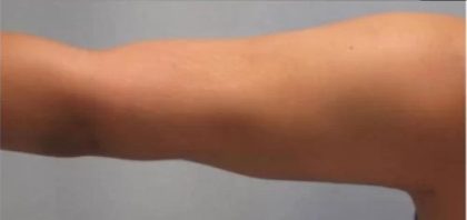 Smartlipo Vaser Lipo Before & After Patient #483