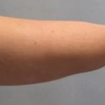 Smartlipo Vaser Lipo Before & After Patient #491