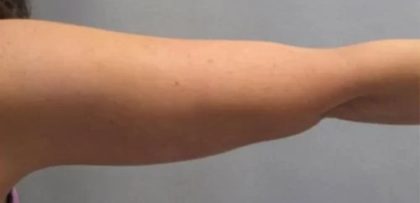Smartlipo Vaser Lipo Before & After Patient #491