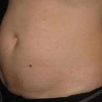 Coolsculpting Before & After Patient #259