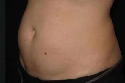 Coolsculpting Before & After Patient #259