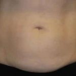 Coolsculpting Before & After Patient #288