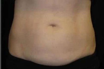 Coolsculpting Before & After Patient #288