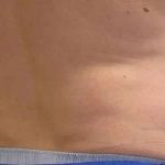 Coolsculpting Before & After Patient #296