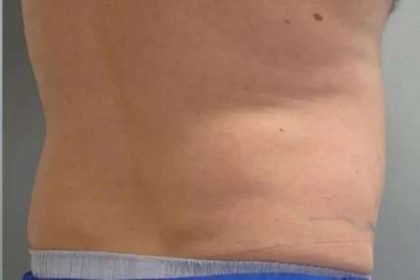Coolsculpting Before & After Patient #296