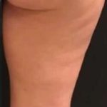 Cellulaze Before & After Patient #362