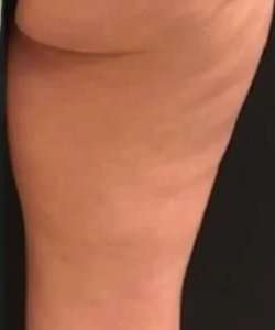 Cellulaze Before & After Patient #362