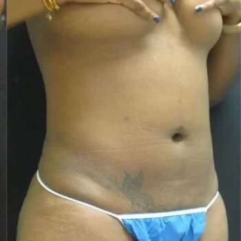 Smartlipo Vaser Lipo Before & After Patient #445