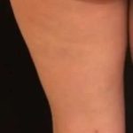 Cellulaze Before & After Patient #362