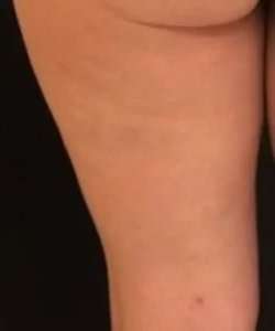 Cellulaze Before & After Patient #362