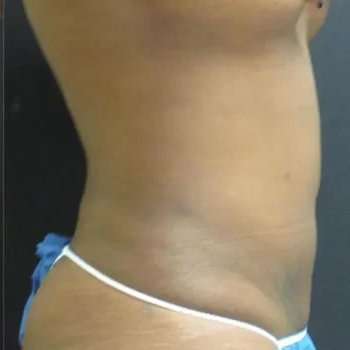 Smartlipo Vaser Lipo Before & After Patient #445