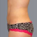 Smartlipo Vaser Lipo Before & After Patient #624