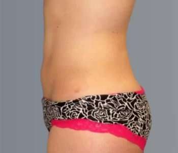 Smartlipo Vaser Lipo Before & After Patient #624