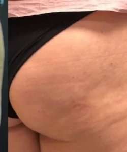 Cellulaze Before & After Patient #362