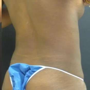 Smartlipo Vaser Lipo Before & After Patient #445