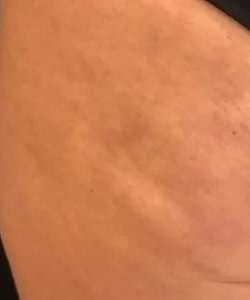 Cellulaze Before & After Patient #362