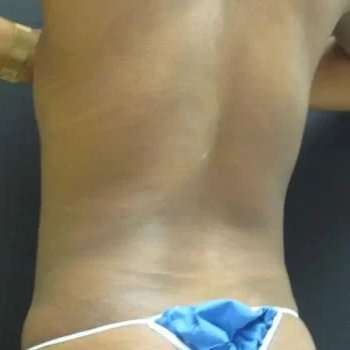 Smartlipo Vaser Lipo Before & After Patient #445