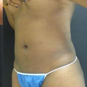 Smartlipo Vaser Lipo Before & After Patient #445