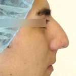 Rhinoplasty Before & After Patient #72