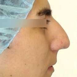 Rhinoplasty Before & After Patient #72