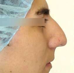 Rhinoplasty Before & After Patient #72