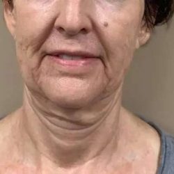 Morpheus8 Before & After Patient #401