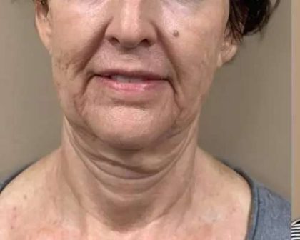 Morpheus8 Before & After Patient #401