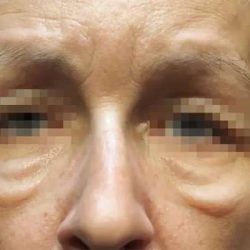 Morpheus8 Before & After Patient #404