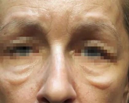 Morpheus8 Before & After Patient #404